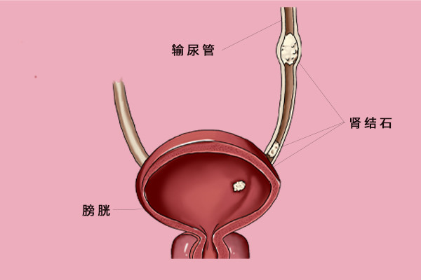 膀胱|一喝水就尿频，是肾不好还是膀胱不好？看完医生的回答，松了口气