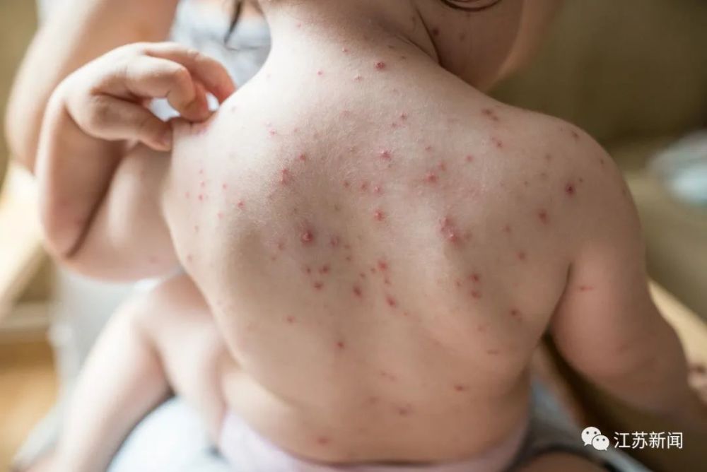 流行性腮腺炎|警惕！近期高发！疾控部门重要提醒！