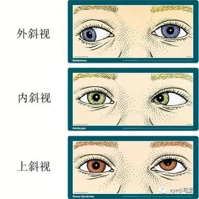 眼性斜颈图片