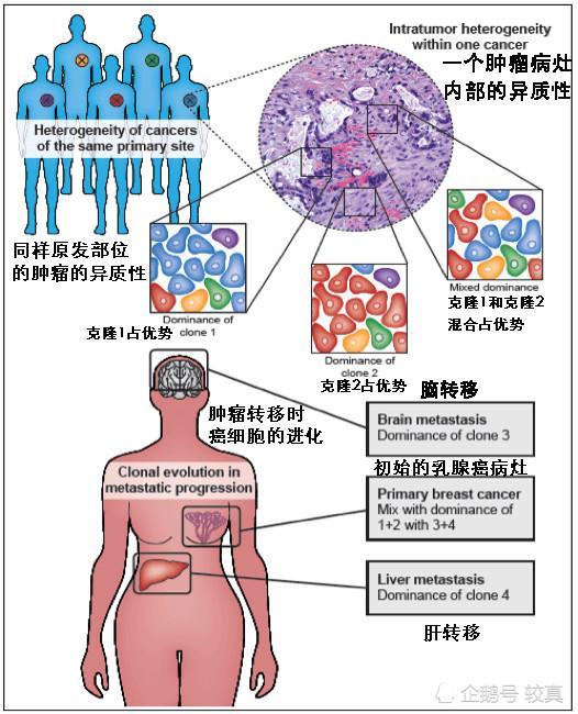 癌症|癌症患者必看！“根治”的癌症为什么还会复发？