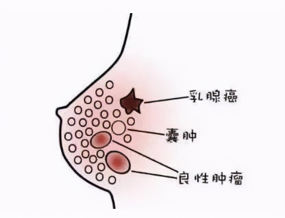 看懂乳腺结节这篇文章就够了