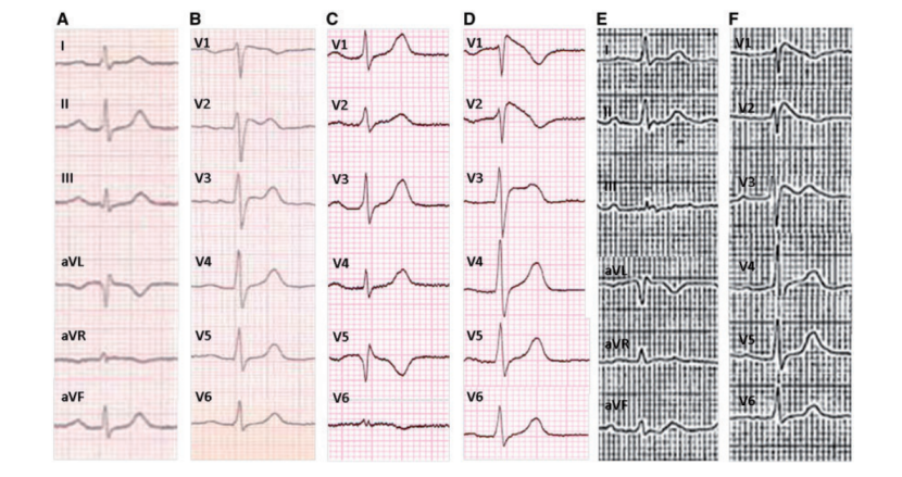 brugada综合征|病例｜它们竟可诱发Brugada综合征室颤发作！