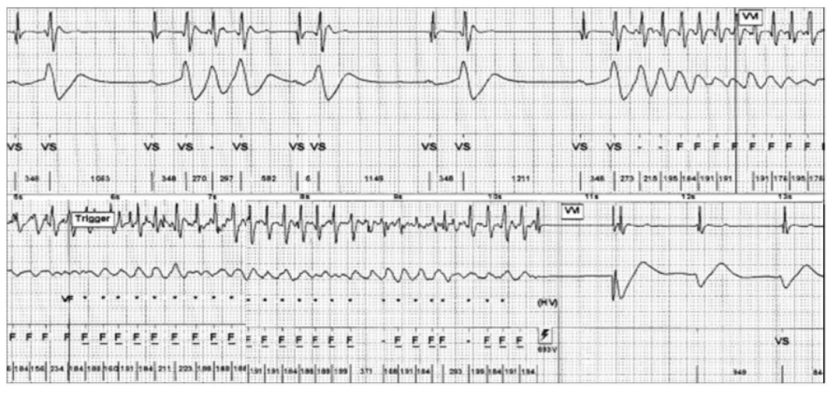 brugada综合征|病例｜它们竟可诱发Brugada综合征室颤发作！