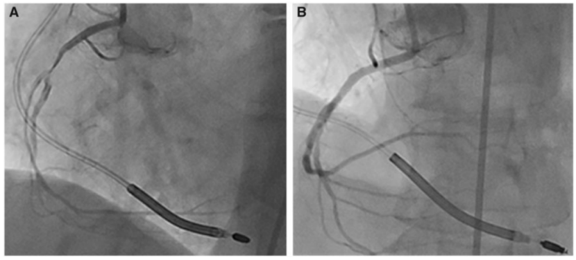 brugada综合征|病例｜它们竟可诱发Brugada综合征室颤发作！