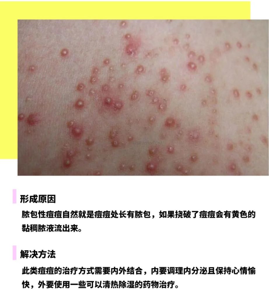 一般长在背上的痘痘分为三个种类:粉刺性痘痘,丘疹性痘痘,脓包性痘痘.