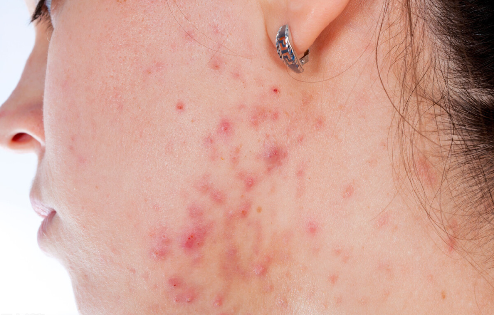 血脂升高,体内的毒素和垃圾不能及时排出,因此在体内堆积,容易在皮肤