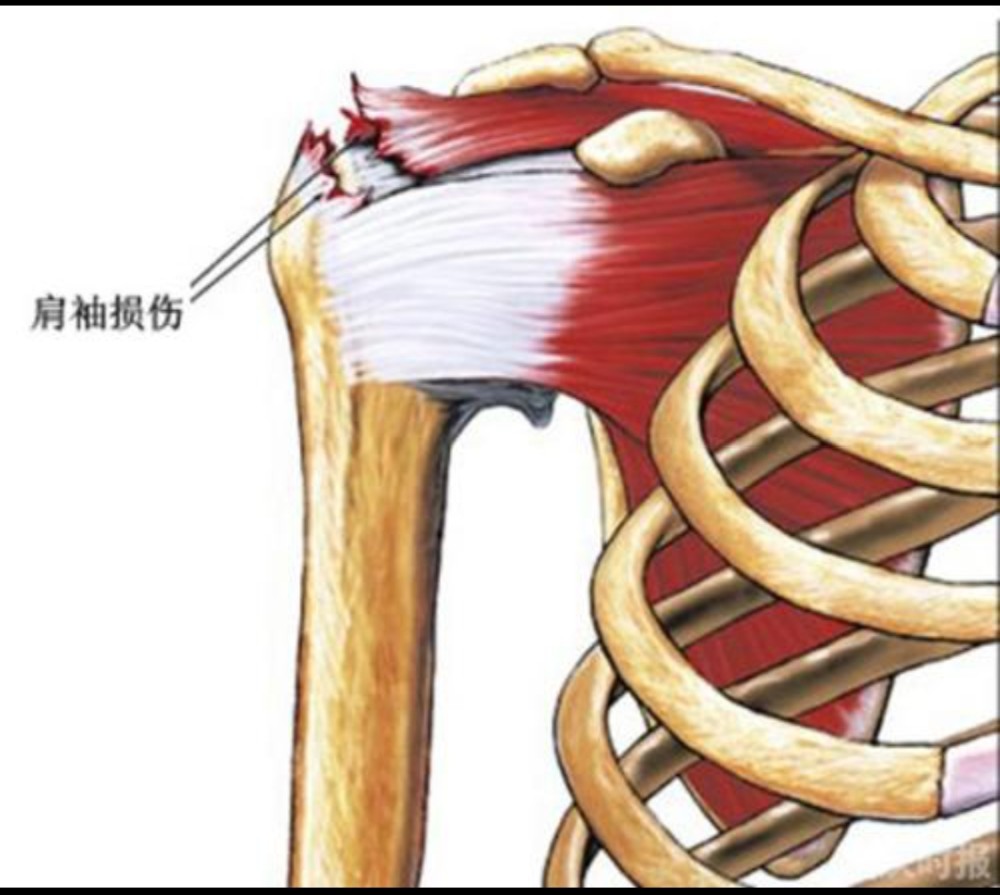 肩袖損傷之後應該怎麼鍛鍊醫生列出動作細節