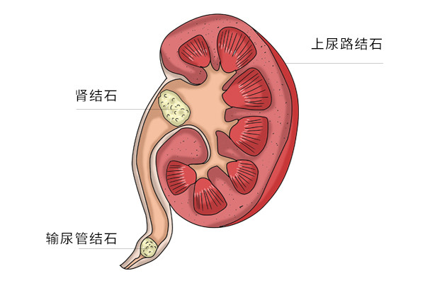 尿酸|尿酸升高时，除了引起痛风，还可能会带来哪些并发症？了解下