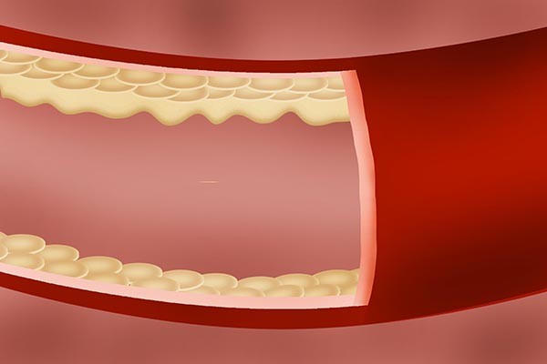 血管|为啥年纪一大，血管会容易堵塞？哪些食物能帮助清除血栓？