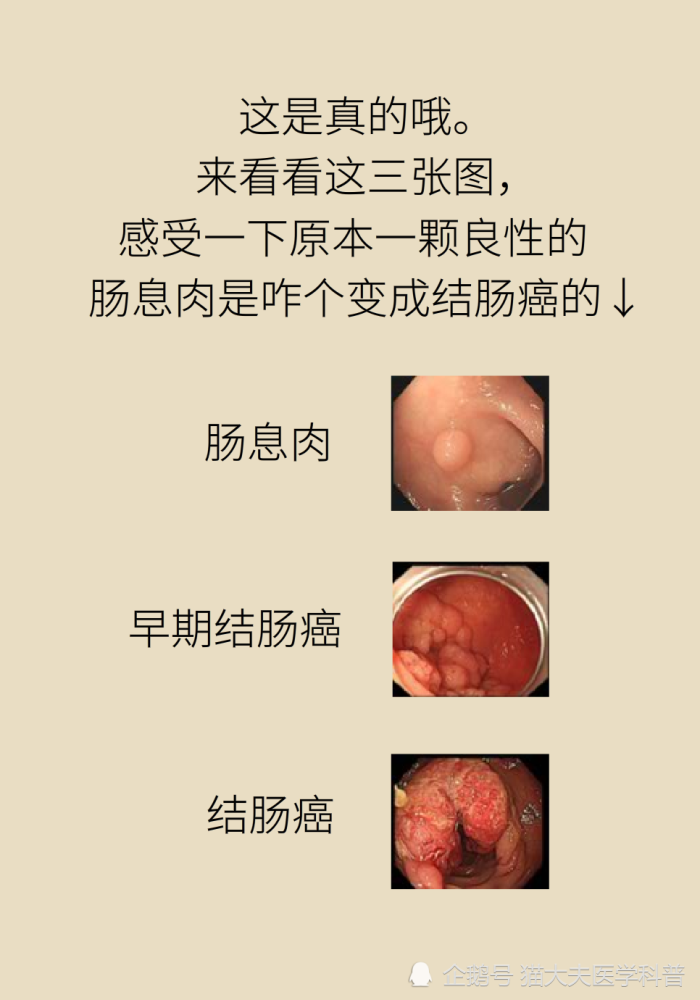 长了肠息肉切不切听说90的大肠癌都是它引起的