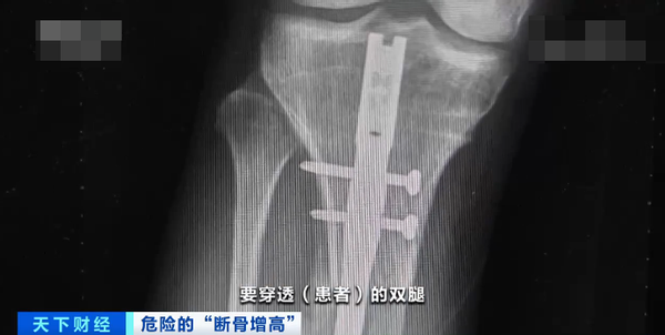 增高|他赴韩“断骨增高”，却面临终身残疾，成年后还有增高的可能吗？