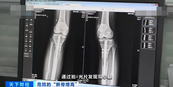 增高|他赴韩“断骨增高”，却面临终身残疾，成年后还有增高的可能吗？