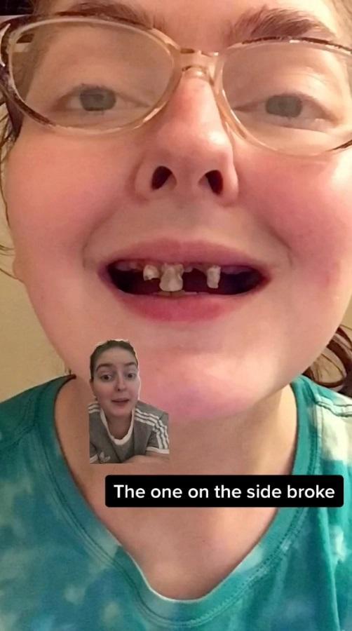 美国女子孕期常喝可乐牙齿腐烂脱落,现只剩3颗,只能装假牙_腾讯新闻