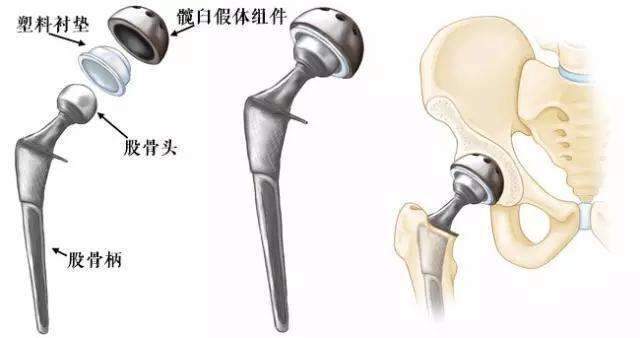 股骨头|股骨头坏死置换材料哪种好_现在人工材质股骨头材料哪种好