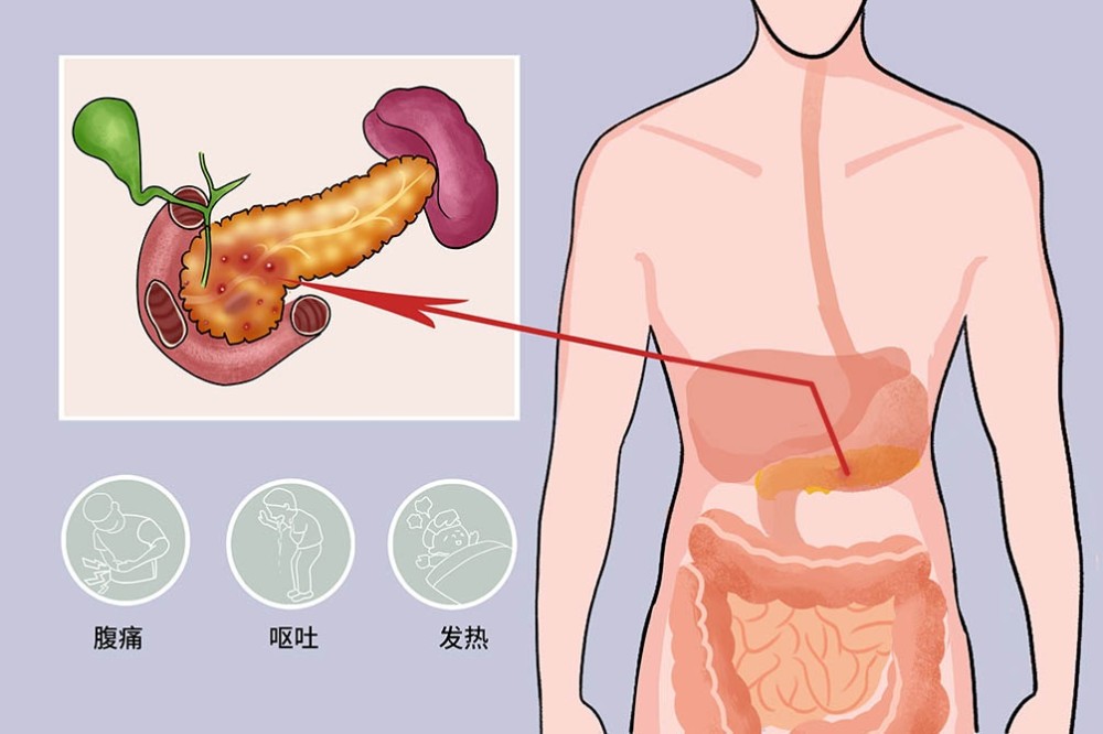 胰腺炎|【知识】暴饮暴食？小心“吃”出胰腺炎！