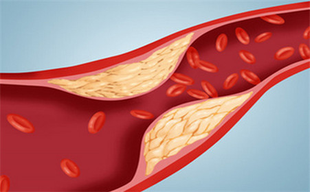 高血脂|胆固醇“清洁工”被找到，若你爱吃，清除坏胆固醇，血脂悄悄下降