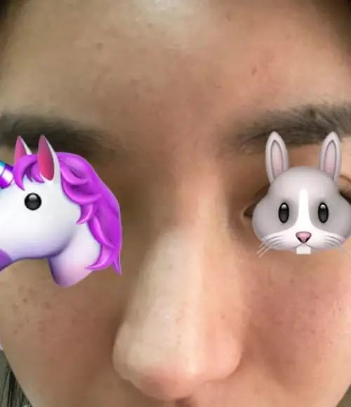 女子在大连新华美天美容医院做鼻子整形,"歪"得没法见人!