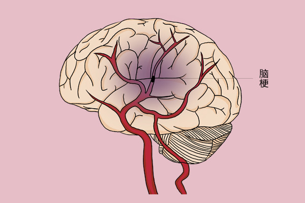 脑梗|脑梗发作后，身体有哪些表现？多长时间内算是“救命黄金期”？