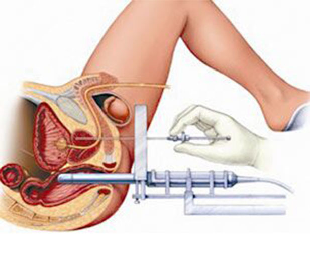 前列腺增生针灸位置图图片