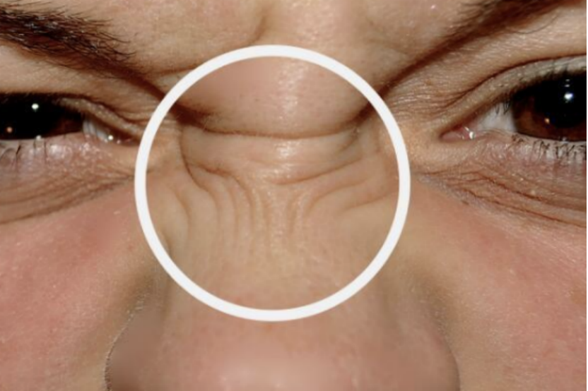 如果鼻子中间出现一道横纹,说明体内脂肪含量已经超标,很有可能是血脂