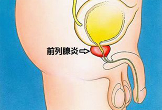 古代前列腺保健按摩图解_前列腺保健按摩的做法_保健按摩前列腺方法