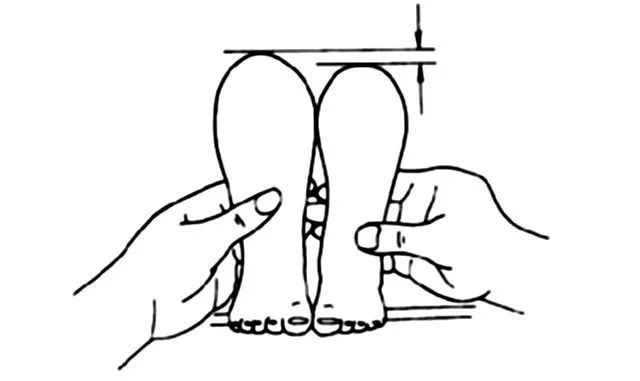 已经学步行走的幼儿,除了臀纹不对称,会阴部增宽,肢体不等长外,还会