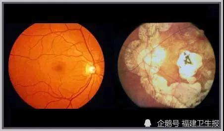 视网膜|小伙坐趟过山车，视网膜“玩脱”了！高度近视的你，要知道这件事