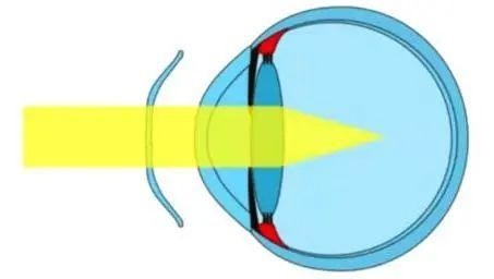 而研究認為周邊視網膜的近視性離焦可保護視力,減緩眼軸增長,控制近視