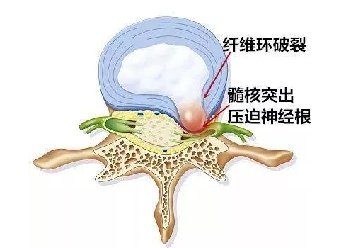 腰椎間盤突出,去醫院檢查,檢查報告沒有顯示壓迫馬尾神經,那為什麼會