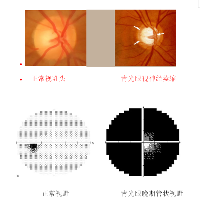 以为用眼过度确诊却是青光眼晚期专家青光眼一定要早防早治