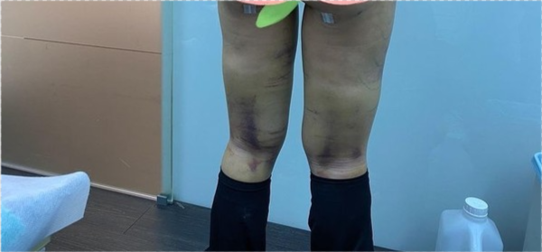 整形需谨慎美女网红抽脂一周后大腿淤青浮肿疼痛自叹像80岁老太太