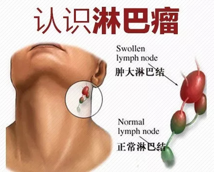 维布妥昔单抗|HSCT＋维布妥昔单抗，深度持久缓解不再是奇迹