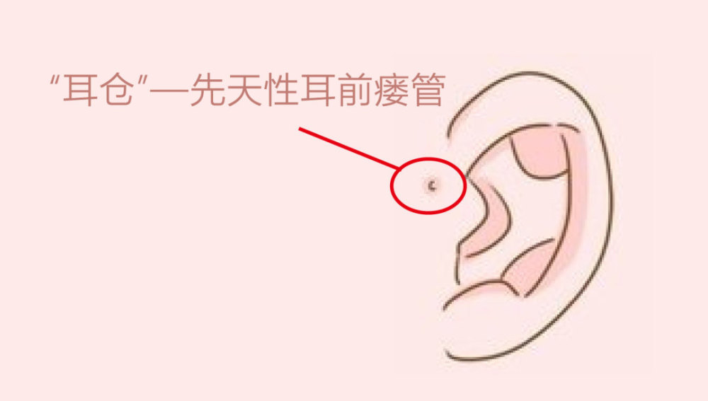 民间俗称的耳仓竟是一种先天性耳疾