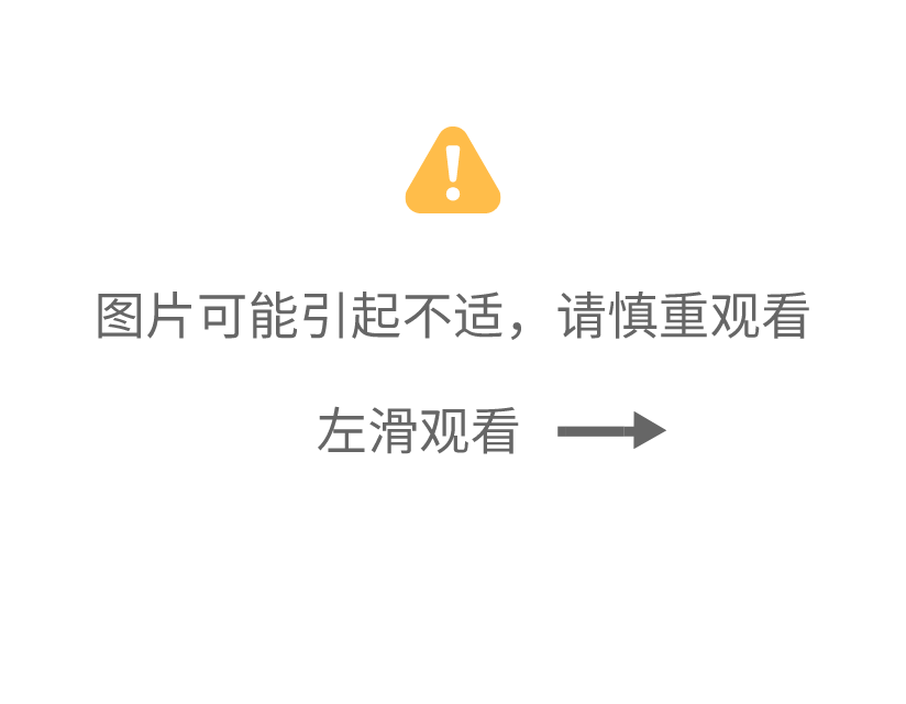 青光眼|不可逆、易致盲的青光眼，别以为年轻人就不会得！