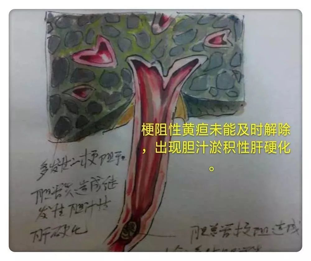 胆囊结石|【图解】胆结石的危害：位置和大小的影响