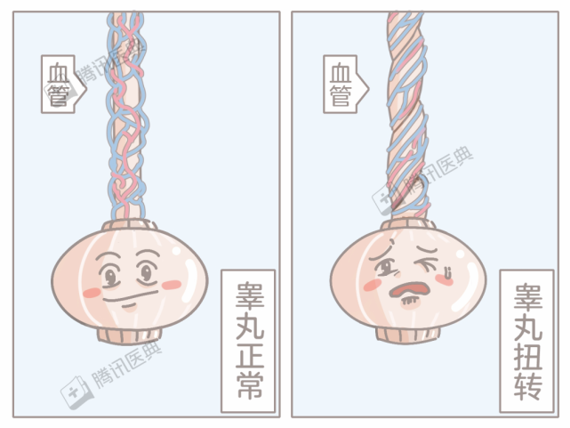 当精索和睾丸一起转动,像麻花一样扭在一起时,就会压迫血管,从而引起