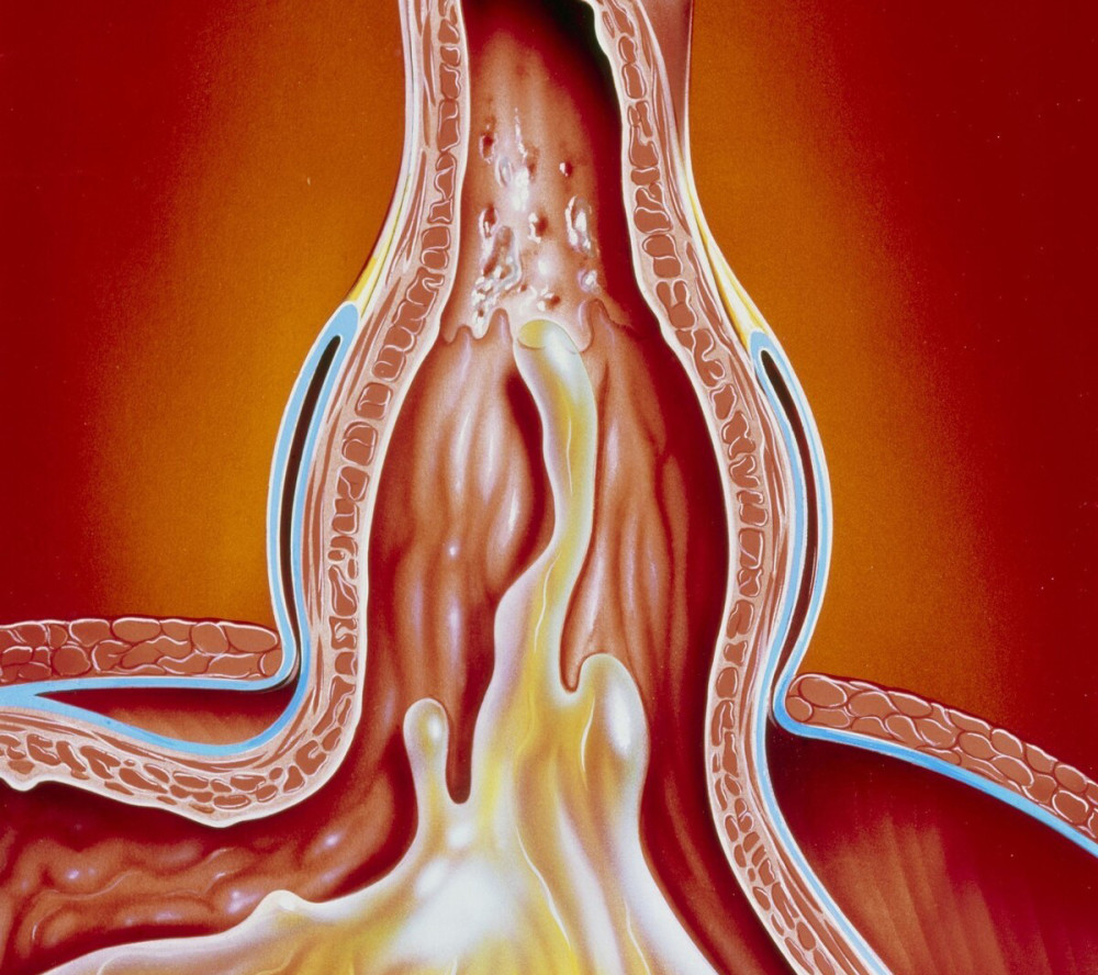 气管|胃对咽喉和气管的偷袭，胃酸是武器，咳嗽是症状，怎样诊断治疗