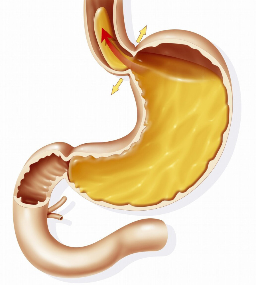 气管|胃对咽喉和气管的偷袭，胃酸是武器，咳嗽是症状，怎样诊断治疗