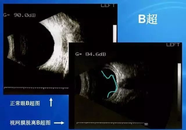 眼底病|眼底病检查与病例分析