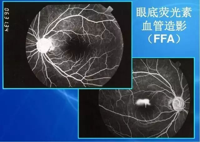 眼底病|眼底病检查与病例分析