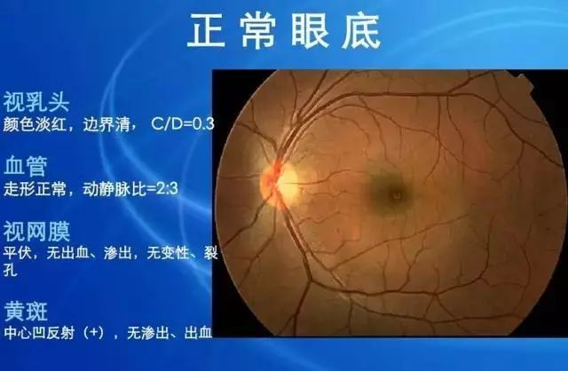 眼底病|眼底病检查与病例分析