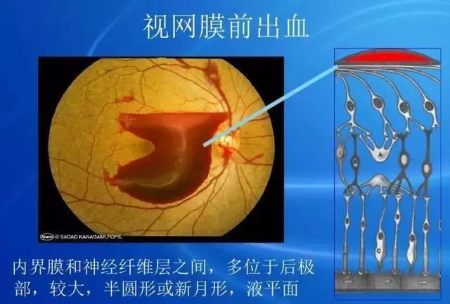 眼底病|眼底病检查与病例分析