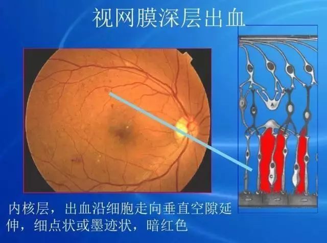 眼底病|眼底病检查与病例分析