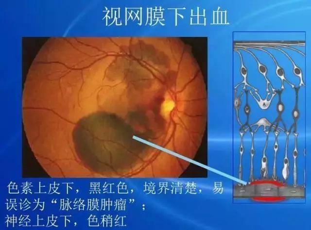 眼底病|眼底病检查与病例分析