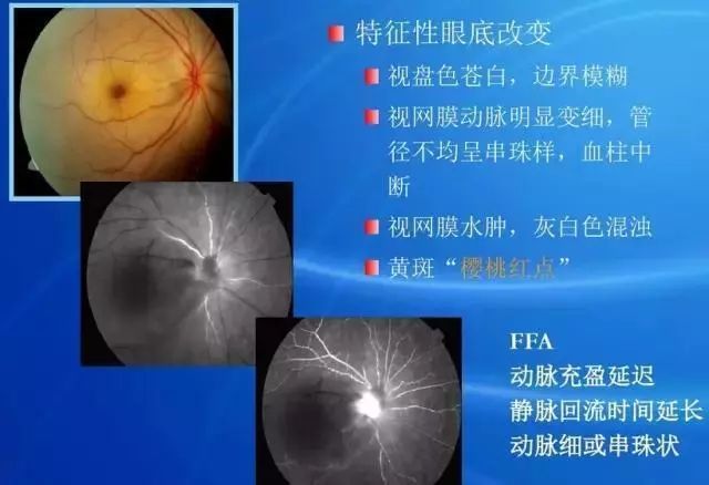 眼底病|眼底病检查与病例分析