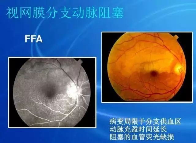 眼底病|眼底病检查与病例分析