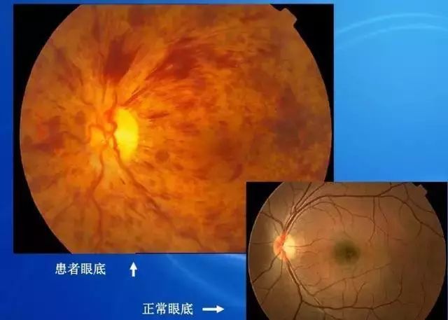 眼底病|眼底病检查与病例分析