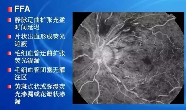 眼底病|眼底病检查与病例分析