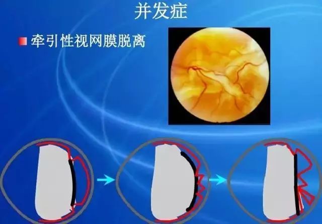 眼底病|眼底病检查与病例分析