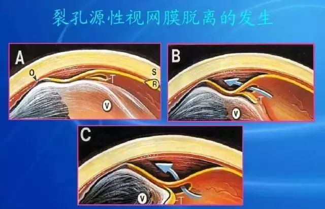 眼底病|眼底病检查与病例分析